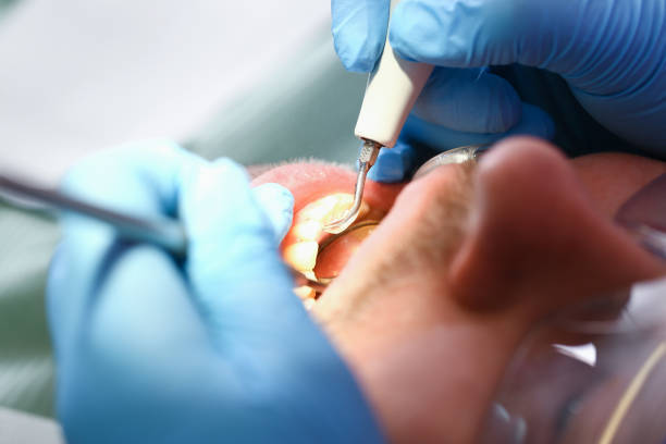 Best Emergency Dental Surgery in Monticello, IL