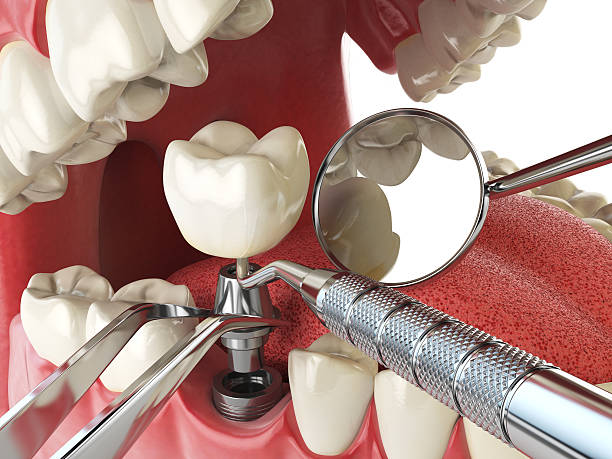 Best Emergency Treatment for Toothache in Monticello, IL